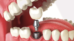 Single Tooth Implant vs Bridge: Pros & Cons for Missing Teeth 